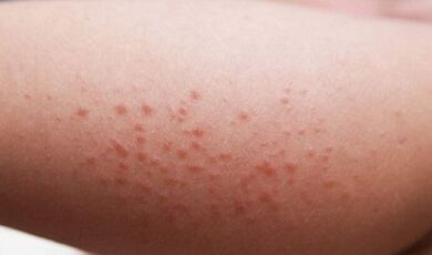 المظاهر الخارجية لوجود الطفيليات في الجسم